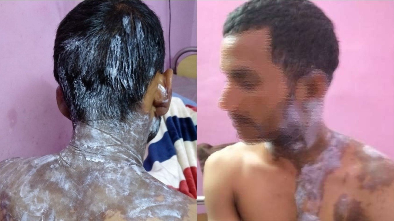 युवक पर युवती ने फेंका तेजाब, पांच महीने से कर रही थी पीछा